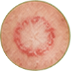Dad - ringworm