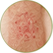 Khaj - scabies
